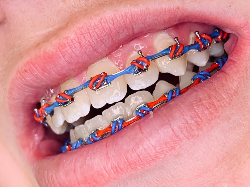 Up close image of a mouth with blue and red braces